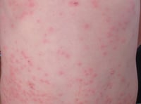 Measles 'outbreak' declared in Gwent as more cases confirmed