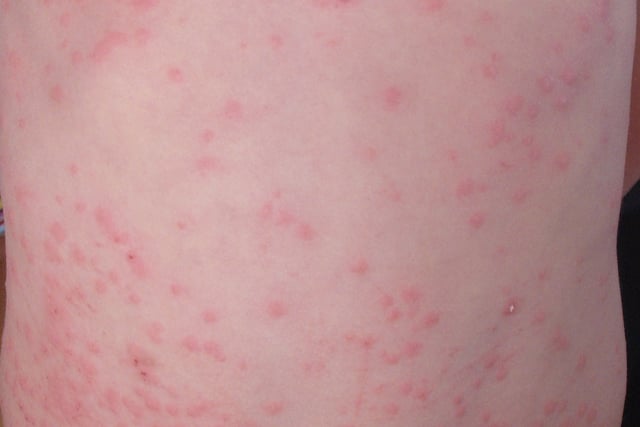 Gwent measles outbreak is over 
