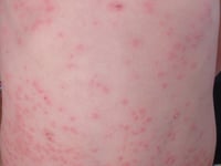 Measles 'outbreak' declared in Gwent as more cases confirmed
