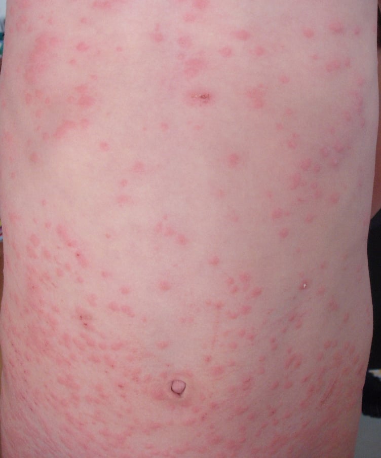 Measles