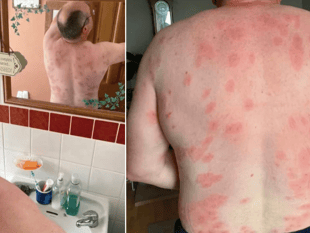 Brecon man survives more than 160 wasp stings thanks to MIU nurses